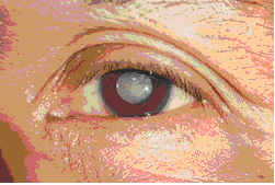 cataract